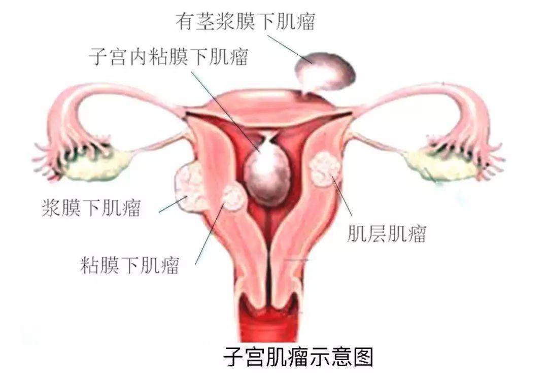 子宫肌瘤的根源