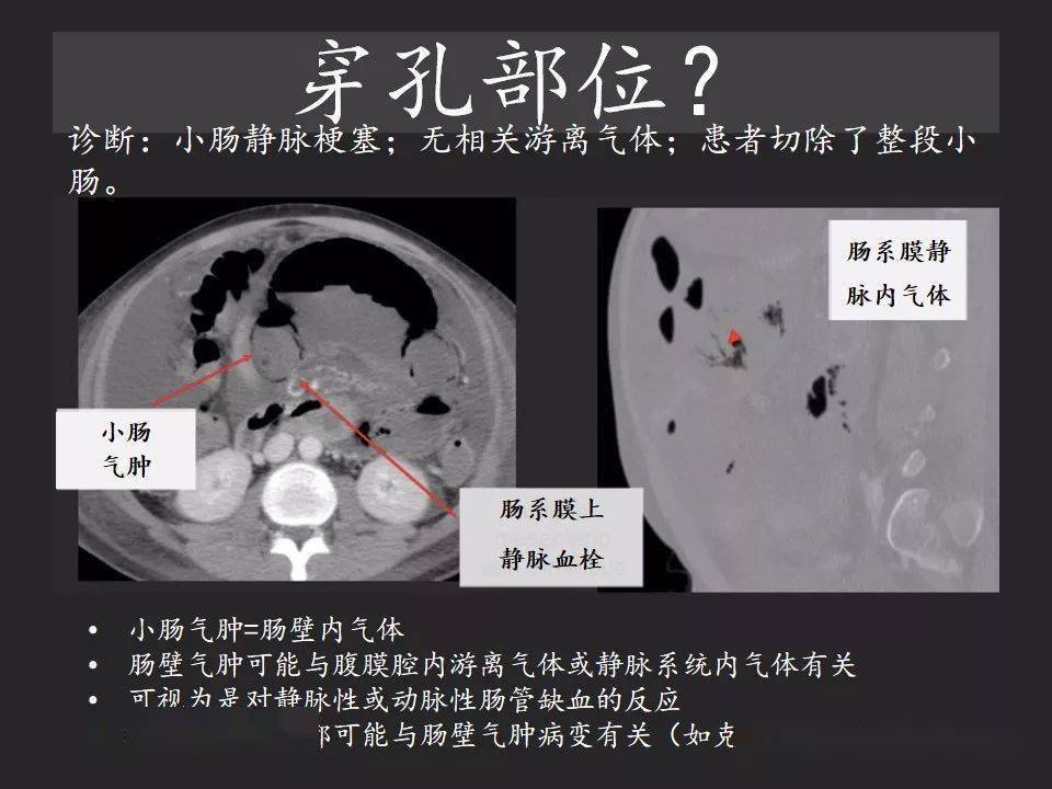 胃肠穿孔气从哪里来通过腹膜解剖确定穿孔部位