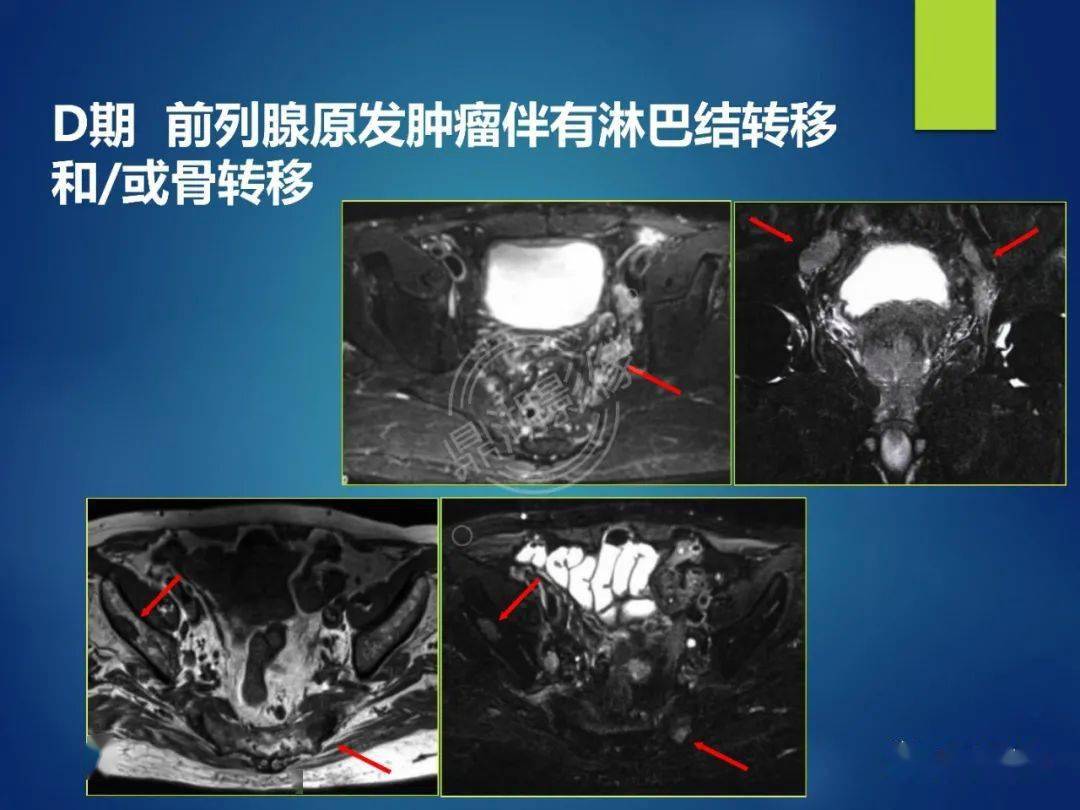 CRPC前列腺癌图片