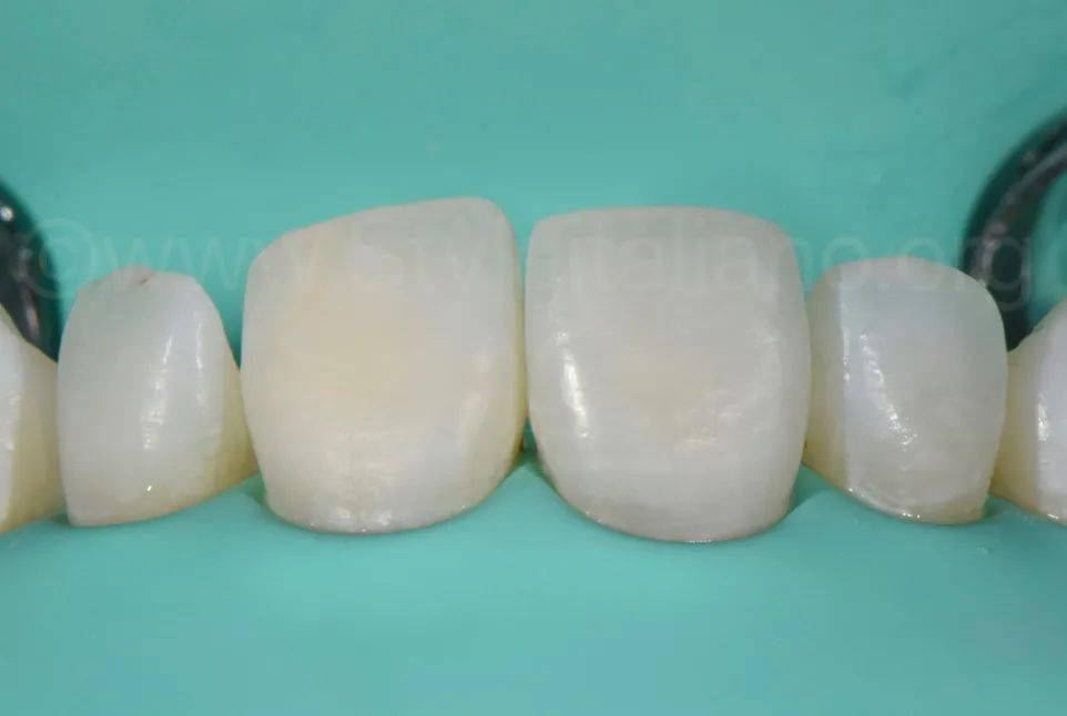 牙医学堂树脂渗透酸蚀终止的时机把握