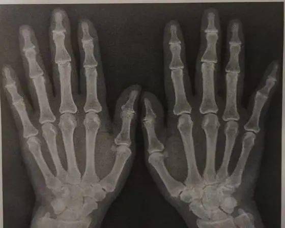 筋骨堂手指关节疼痛变形是骨关节炎还是类风湿