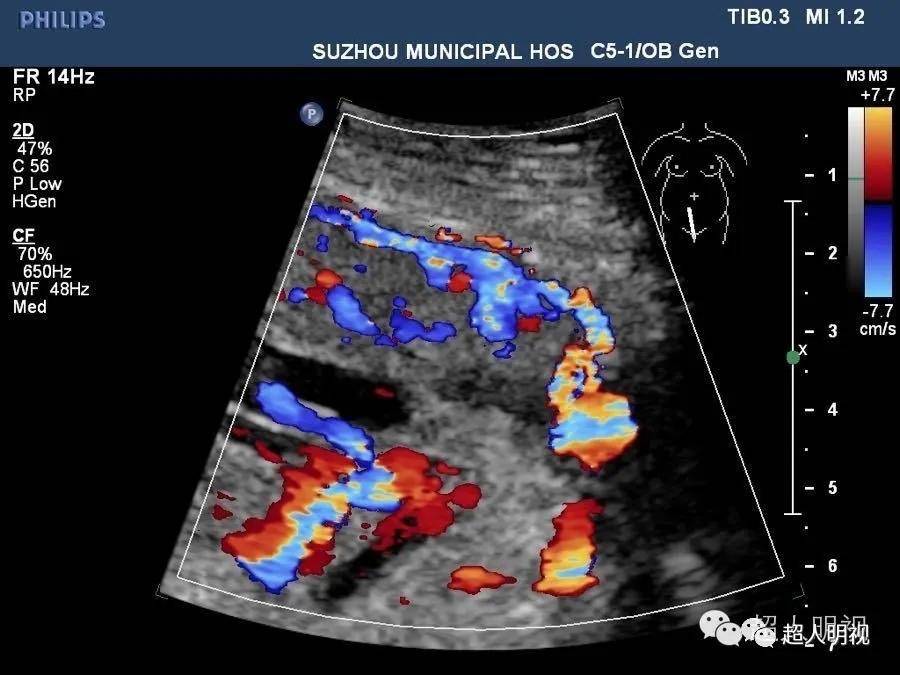 再聊聊胎盘植入