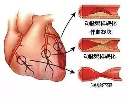 20張圖片詳解心血管疾病值得收藏