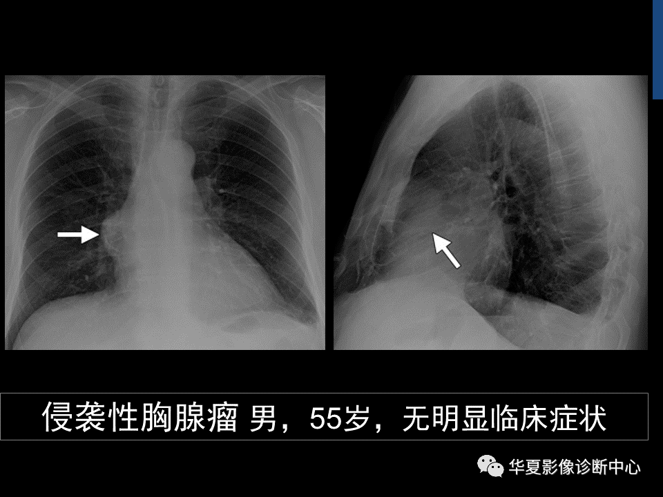 胸腺瘤ct表现图片