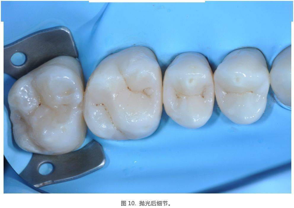 10个后牙直接充填注意点