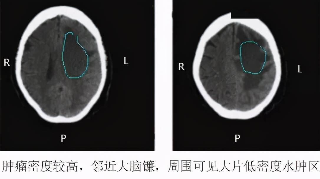 认识这几种头颅 ct,值夜班稳了