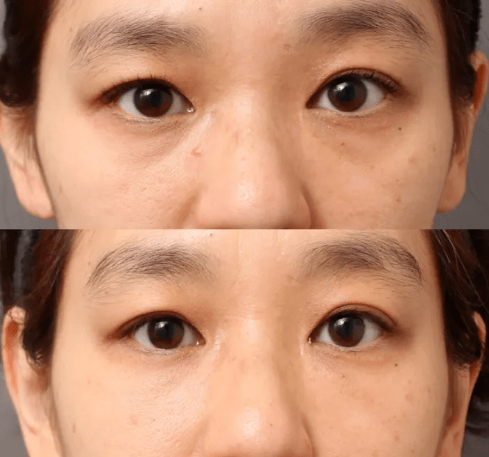 【医美在线】完美实现眶周年轻化,向衰老say byebye!_黑眼圈