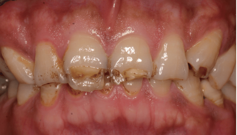 牙齿钙化不全的图片图片
