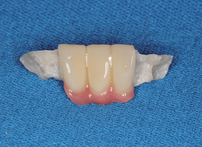 粘接固定义齿对于前牙缺失,两侧基牙因牙周病而松动的患者,使用玻璃