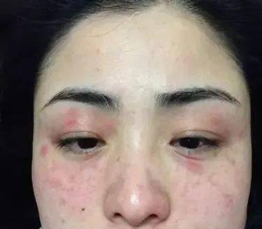 什么是干敏?什么是油敏?什么是激素敏?_皮肤