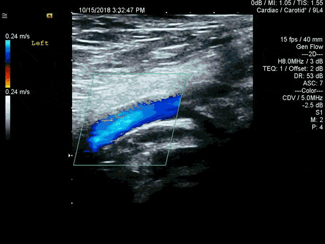 上肢血管超声检查图片