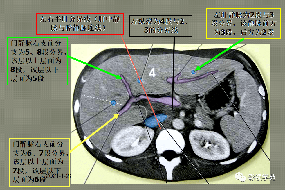 ct肝脏分叶分段解剖图图片