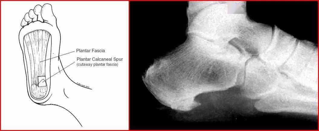 跟骨足底骨刺致病機制2機械性因素1病理學足跟脂肪墊炎或萎縮足跟內