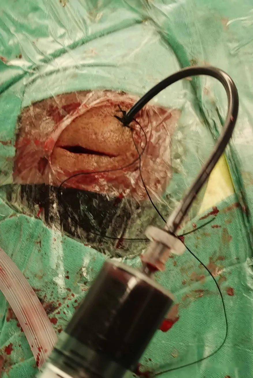 图中显示,手术切口不及注射器直径大(约2cm)图示:切口外贴敷一最小号