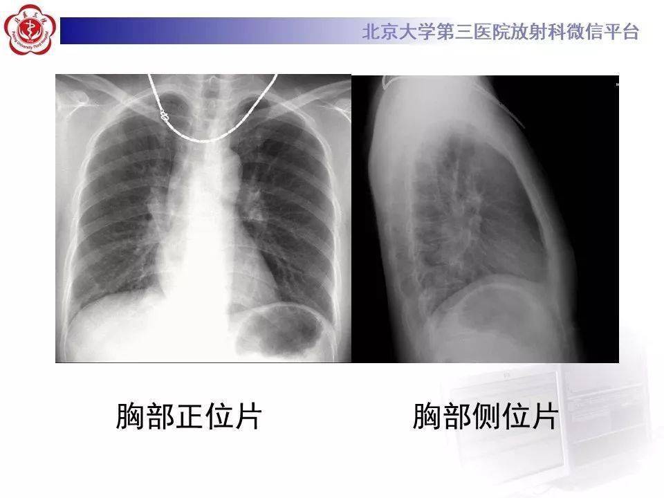 胸片侧位示意图图片