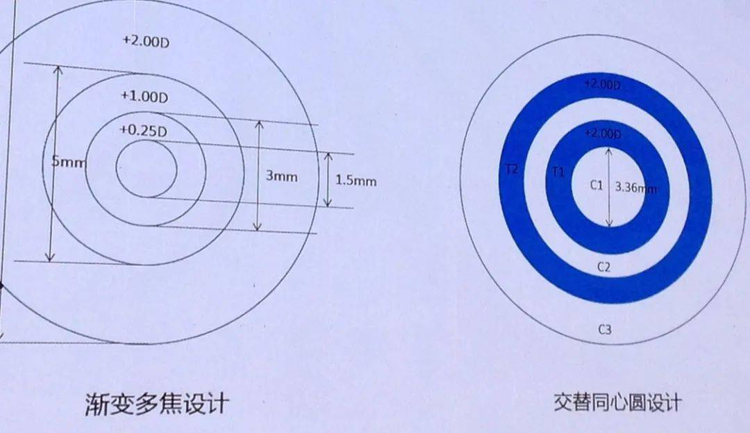 姜珺控制近视的又一利器多焦软镜