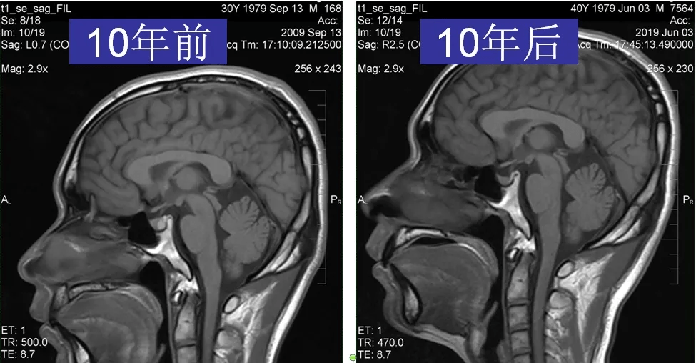 看完14个病例一起来认识这个表现多样的rathkes囊肿