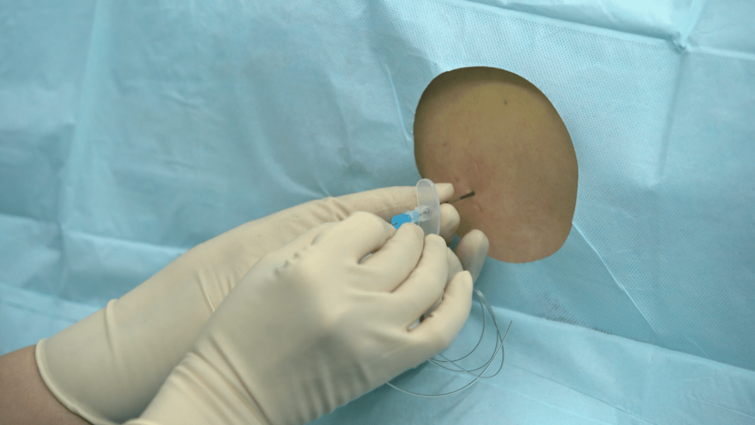 腰麻用药可根据临床需要配比为重比重或轻比重药液,便于调节麻醉平面.