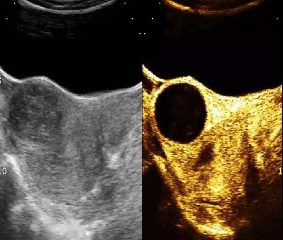 病例分享超声引导下子宫肌瘤聚桂醇硬化治疗