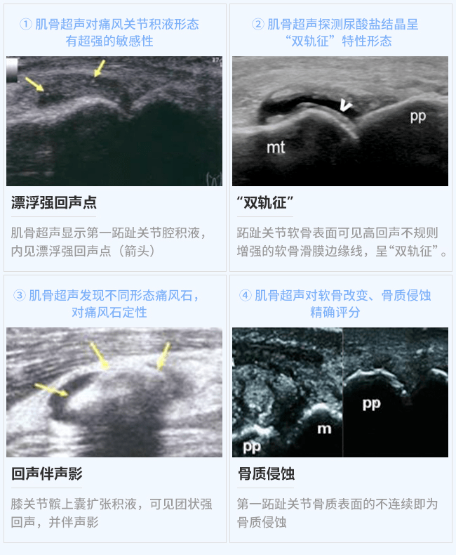 痛风肾超声图片图片