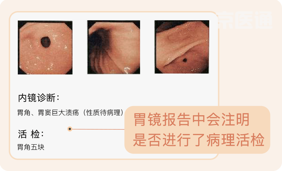 胃鏡報告和病理報告一起看專家解讀:如果出現這類診斷名詞,要及時去