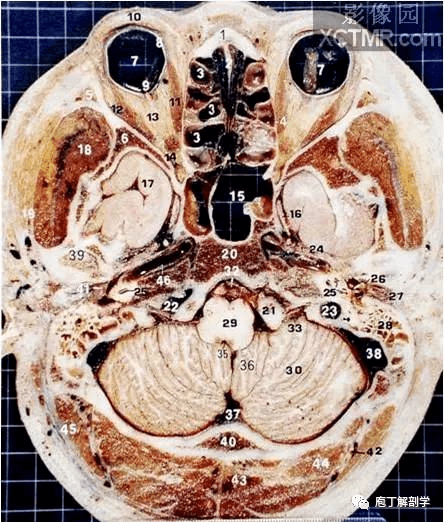 经典大体颅脑断层解剖图横断面