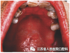 假牙搭不上怎么办_假牙套在真牙上图片