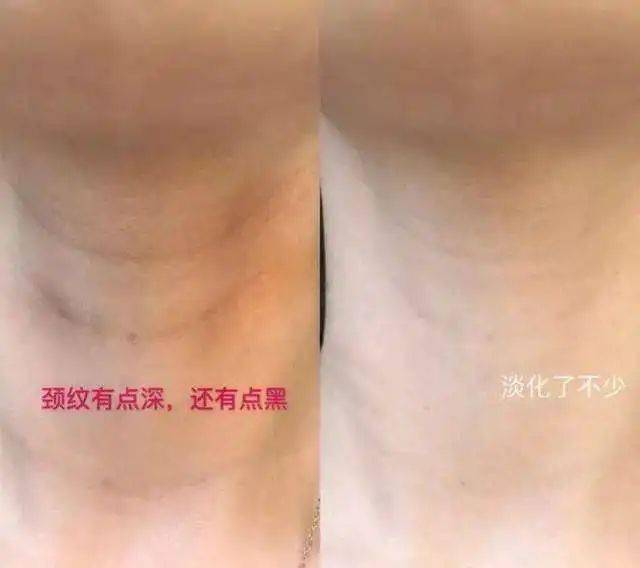怎样能减少颈纹 7b2f6e81bfa9491ebfd71b8161afc5e6.jpeg