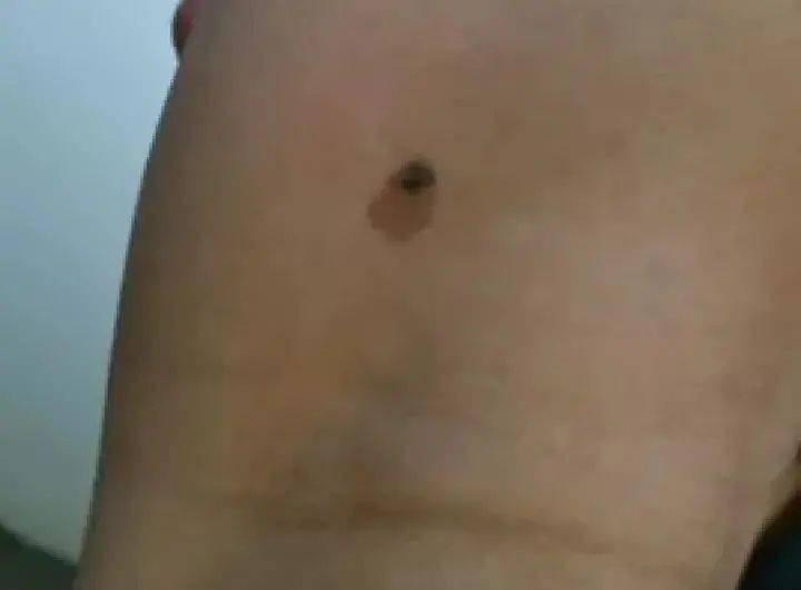 男,49岁,右腿膝盖后方,直径1厘米.医生建议:形状颜色不均匀,建议切除.