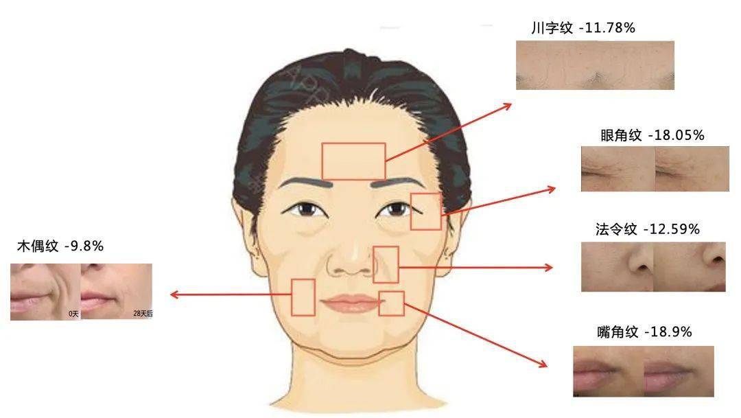 一条纹老十岁 那么 让真性皱纹晚出现十年可能吗 氨基酸