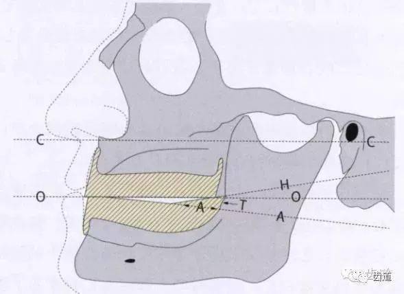 对于颌位关系异常的病例,在确定禾平面时,应以下颌牙槽嵴最后处的凸起