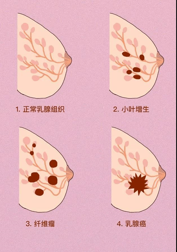 乳房早期桔子皮状图片图片