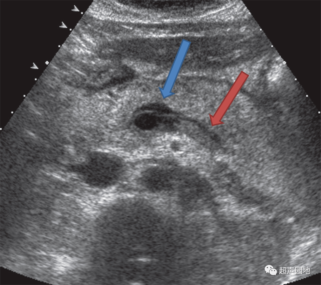 超基础这样的急性胰腺炎就离谱欢迎关注超声园地一起巩固超声基础知识