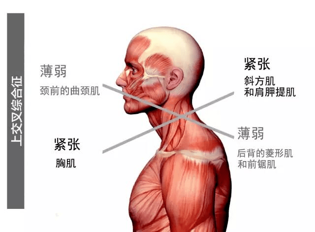 圓肩駝背頭前傾這些體態是不是很彆扭