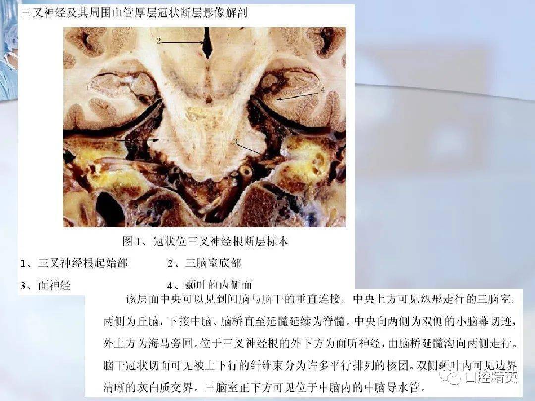 三叉神经疼解剖及三叉神经痛影响诊断