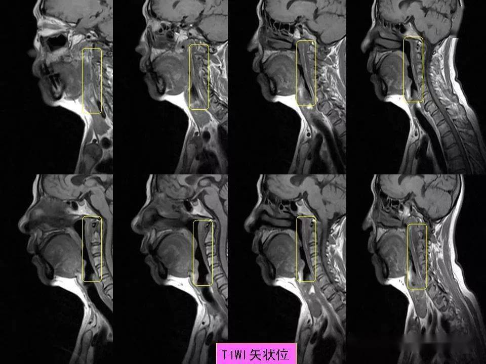 颈椎核磁图解图片