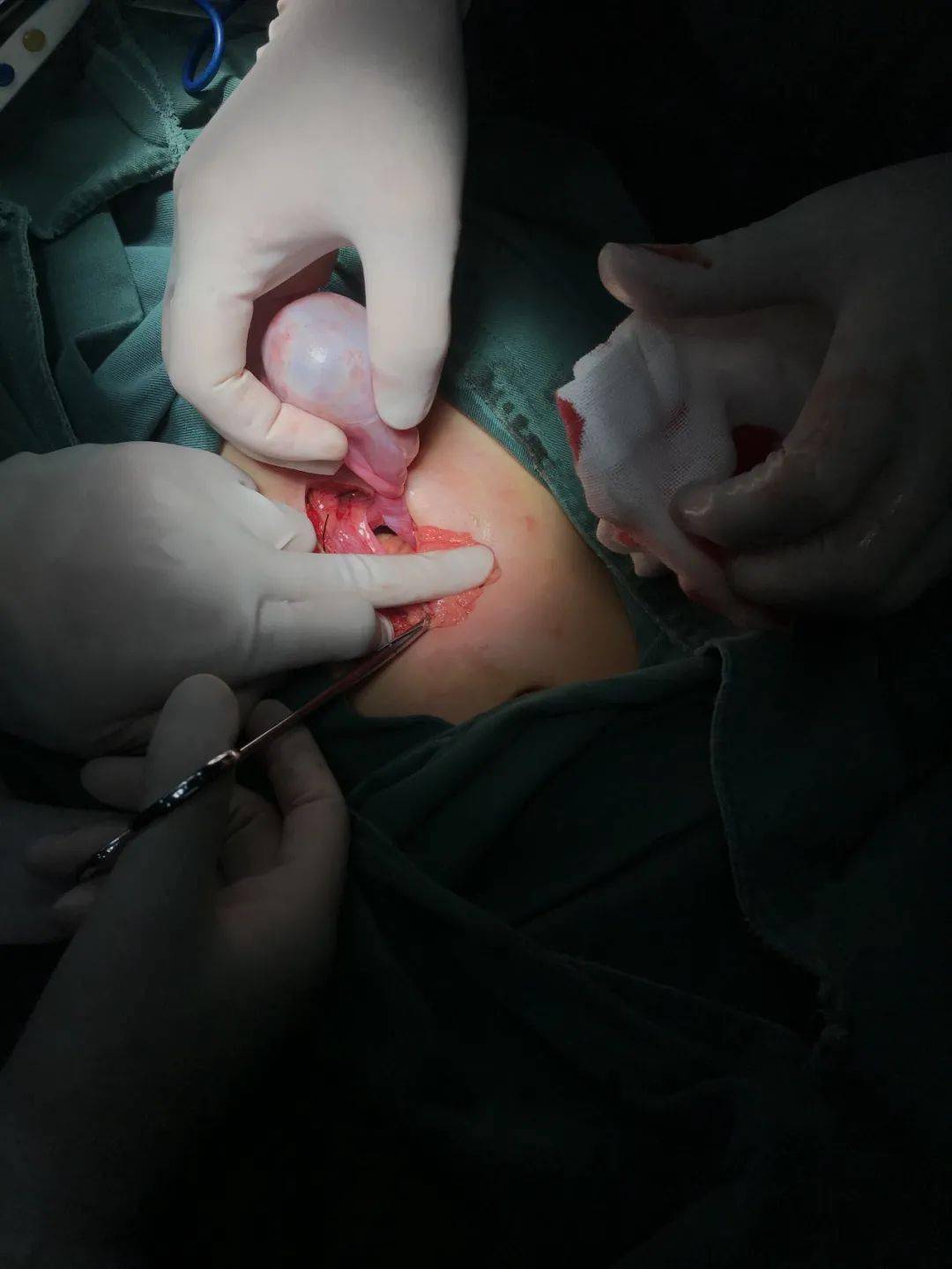 麻醉,入腹,探查,确如术前判断,4cm 卵巢畸胎瘤蒂扭转,足足旋转1080度