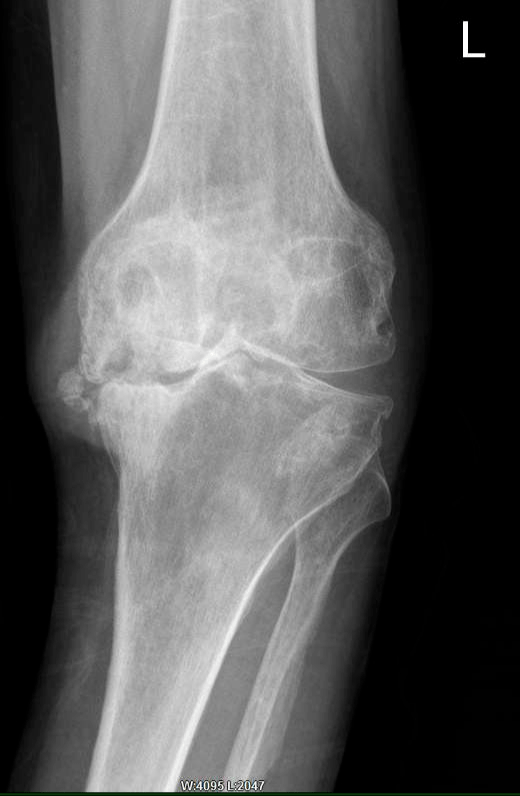 膝关节置换医院排名_膝关节置换图片