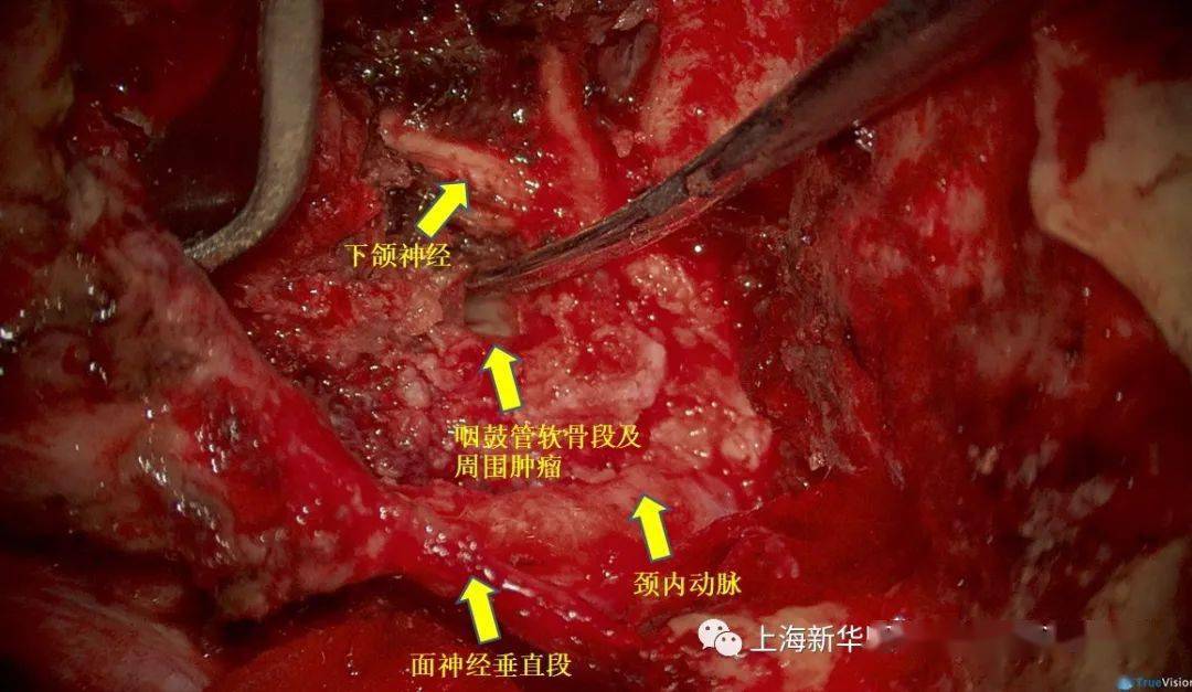 颞下窝肿瘤图片