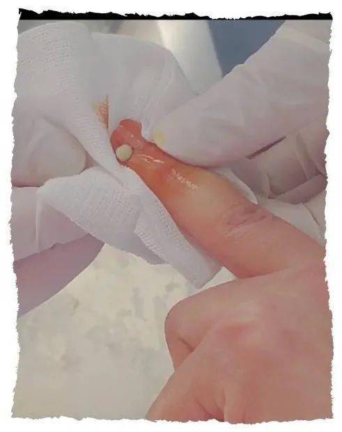 倒刺到底怎么拔千万别手欠这个小动作让女演员住院