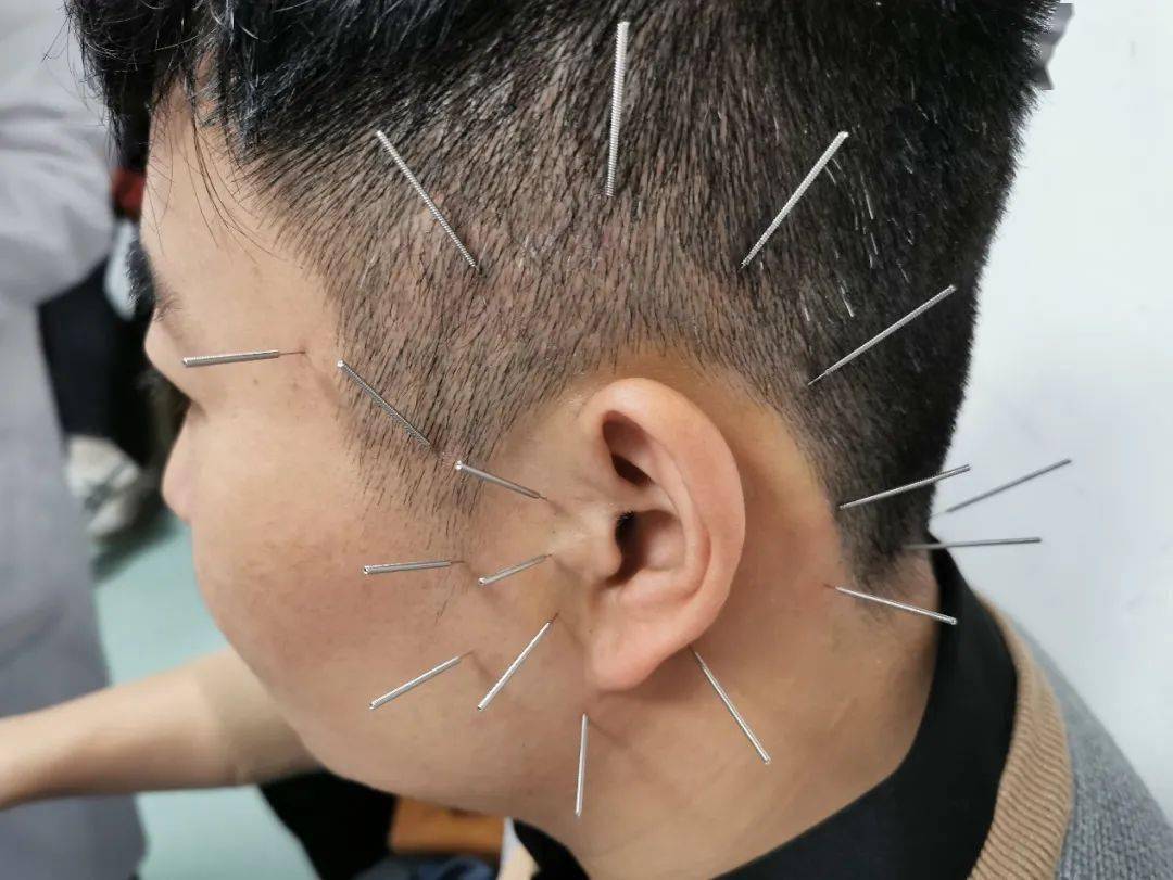 【爱耳日】精准防聋治聋 助力健康中国_耳聋