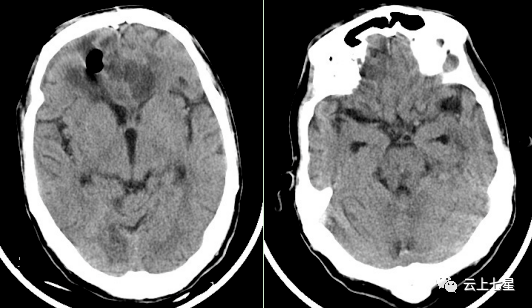 术后头颅ct,显示右侧巨大气颅基本吸收,左侧脑出血已清除据了解该
