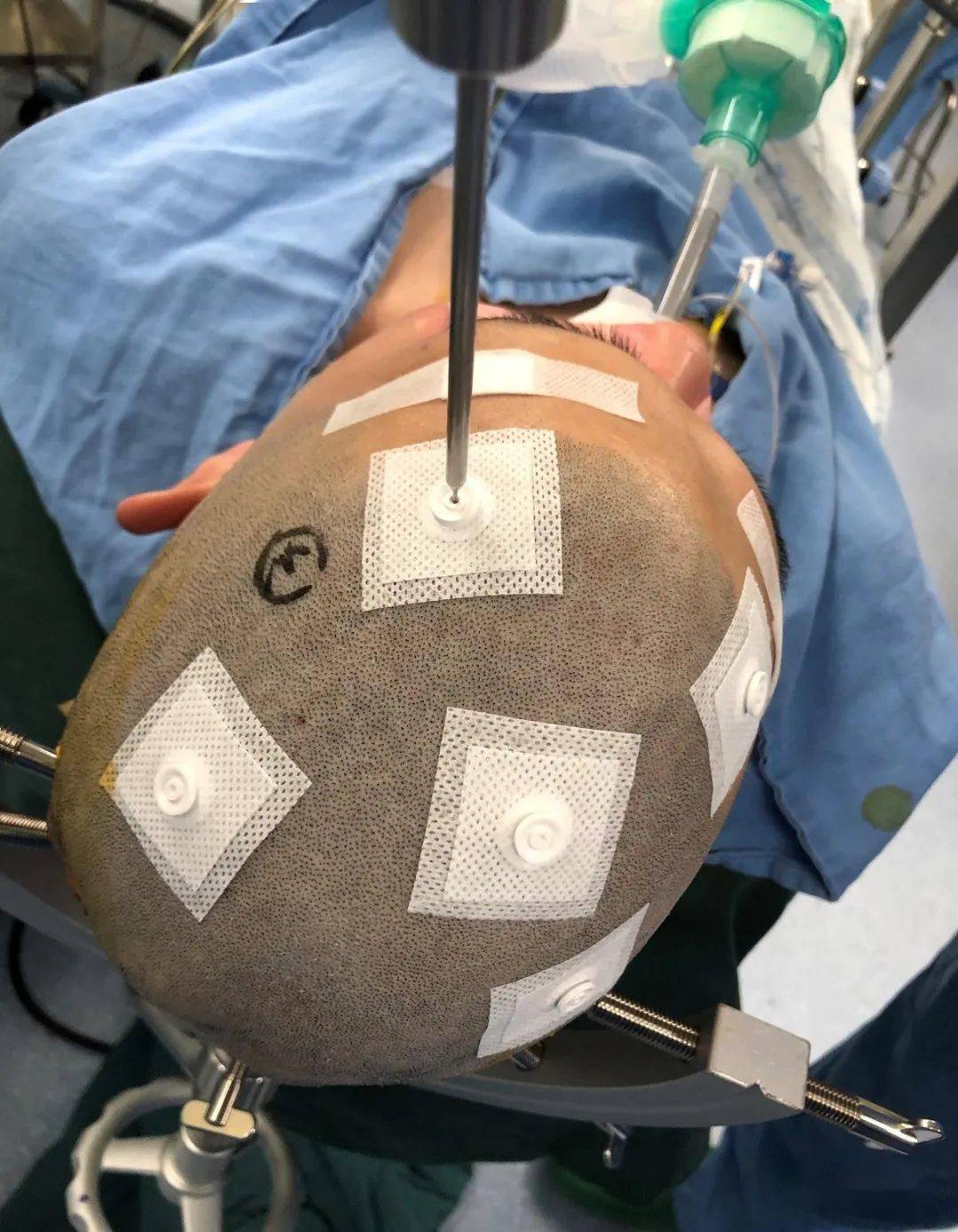 睿米特约机器人辅助开颅如何用导引管线克服脑组织漂移难题浙江省立