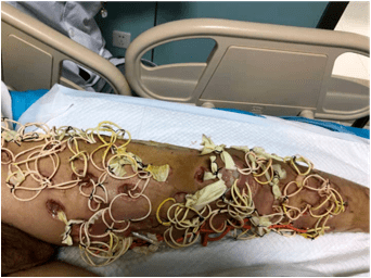 跨年战役团队协作战胜坏死性筋膜炎图片真实胆小慎入