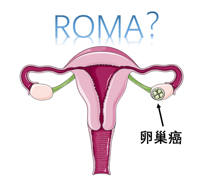 卵巢癌与肿瘤标志物罗马指数roma篇