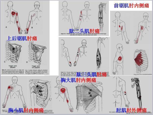 腕和手外侧痛主要激痛点桡侧腕短伸肌(extensor carpi radialis