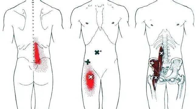 髂腰肌疼痛示意图1)用手指按压股骨小转子上方的股三角外侧缘深部