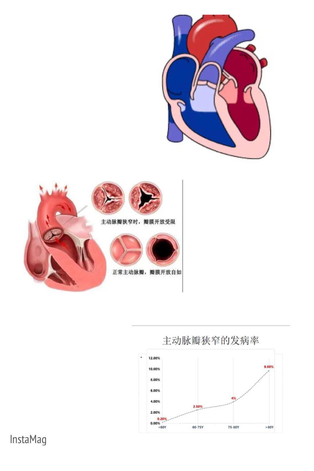 主动脉瓣在哪个位置图片