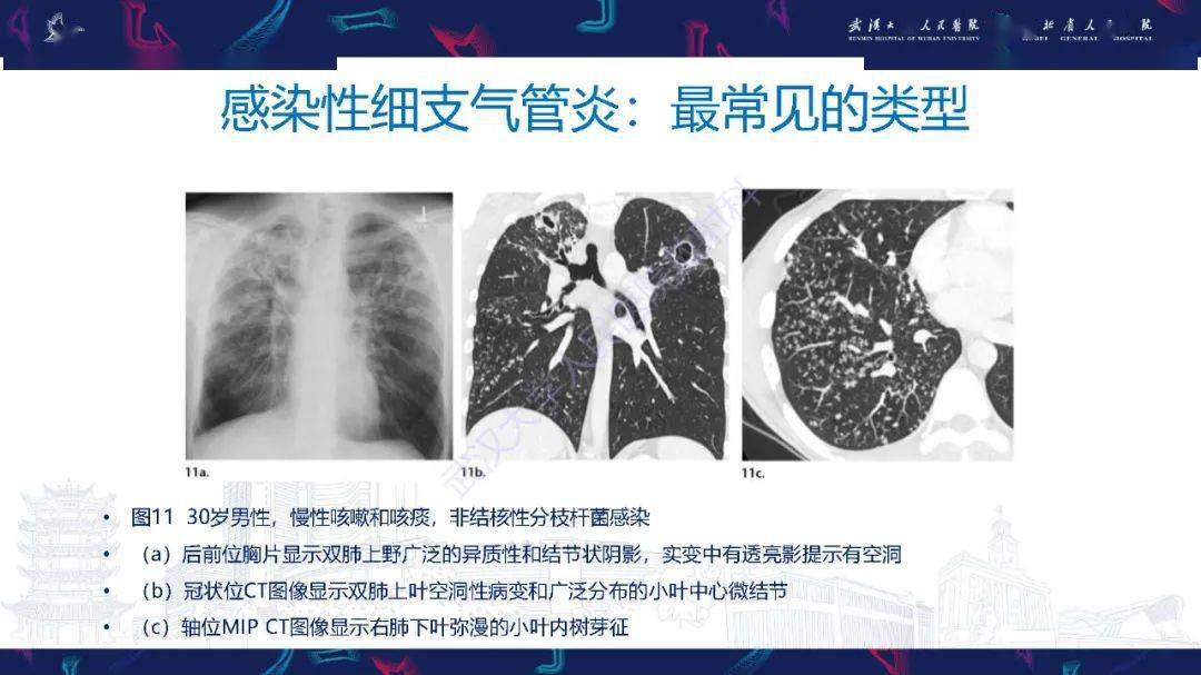 細支氣管炎影像診斷