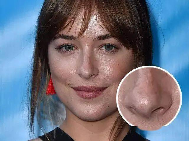 黑头不去除,皮肤会越来越油腻,尤其到了夏天,一张大油脸,任谁看到都会